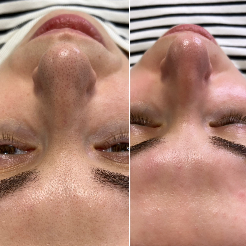 Чистка лица
HydraFacial