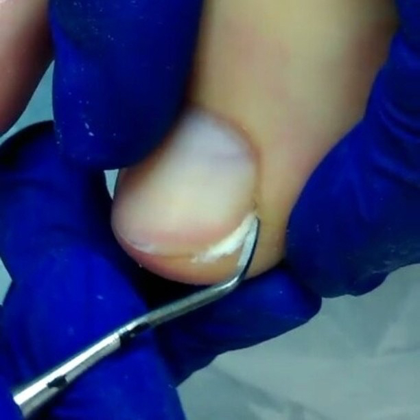 Установка тампонады