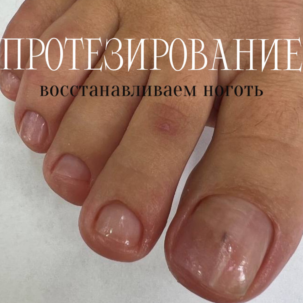Протезирование ногтевой пластины (на материале Arkada)