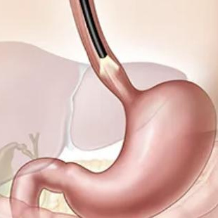 Гастроскопия