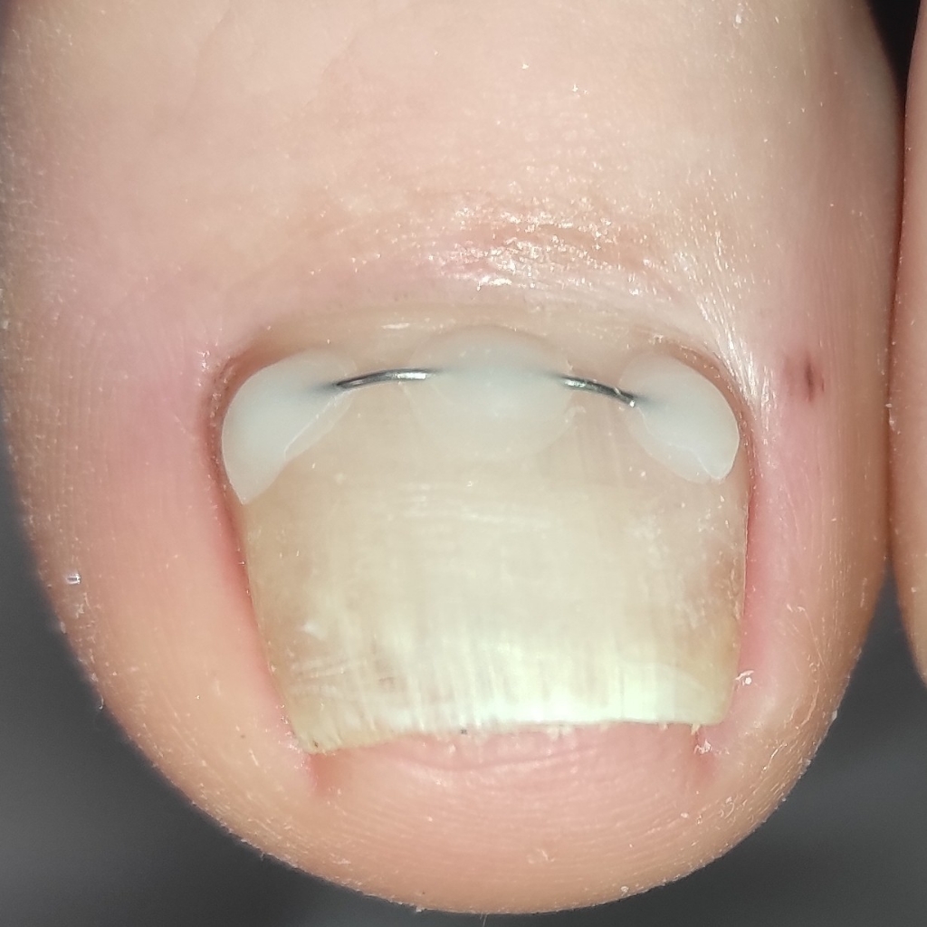 Установка титановой нити 2 больших ногтя