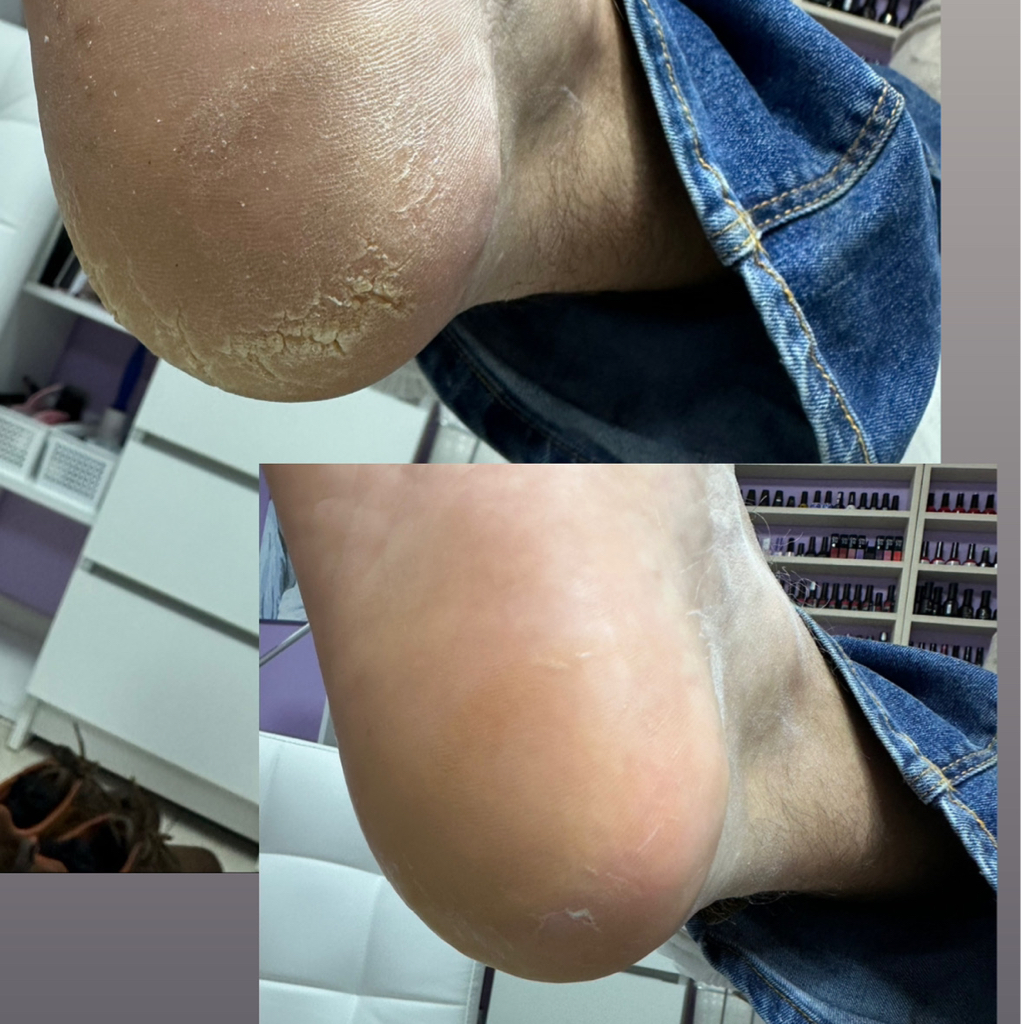 Обработка глубоких трещин на стопах