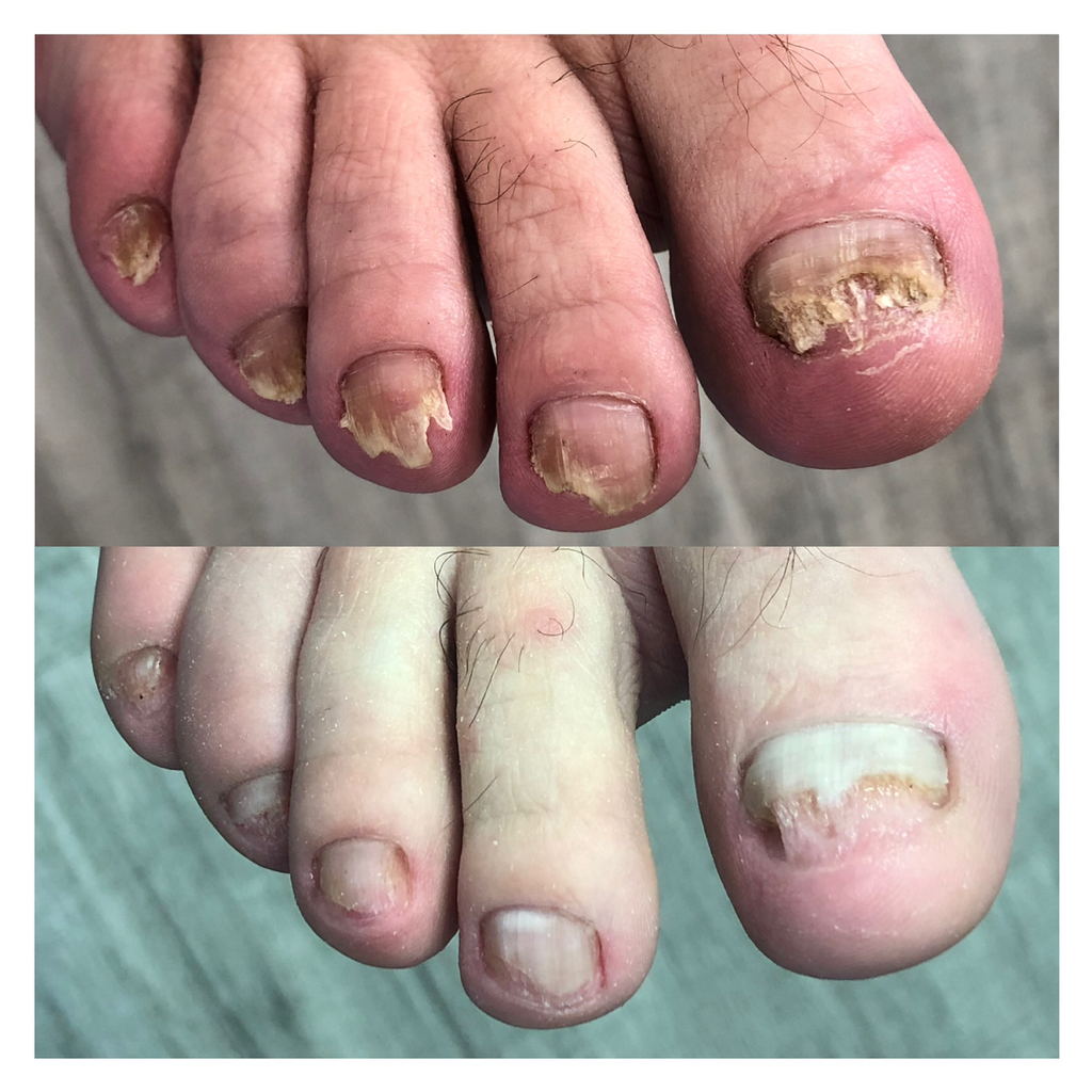 Частичная обработка от 6-10 проблемных ногтей