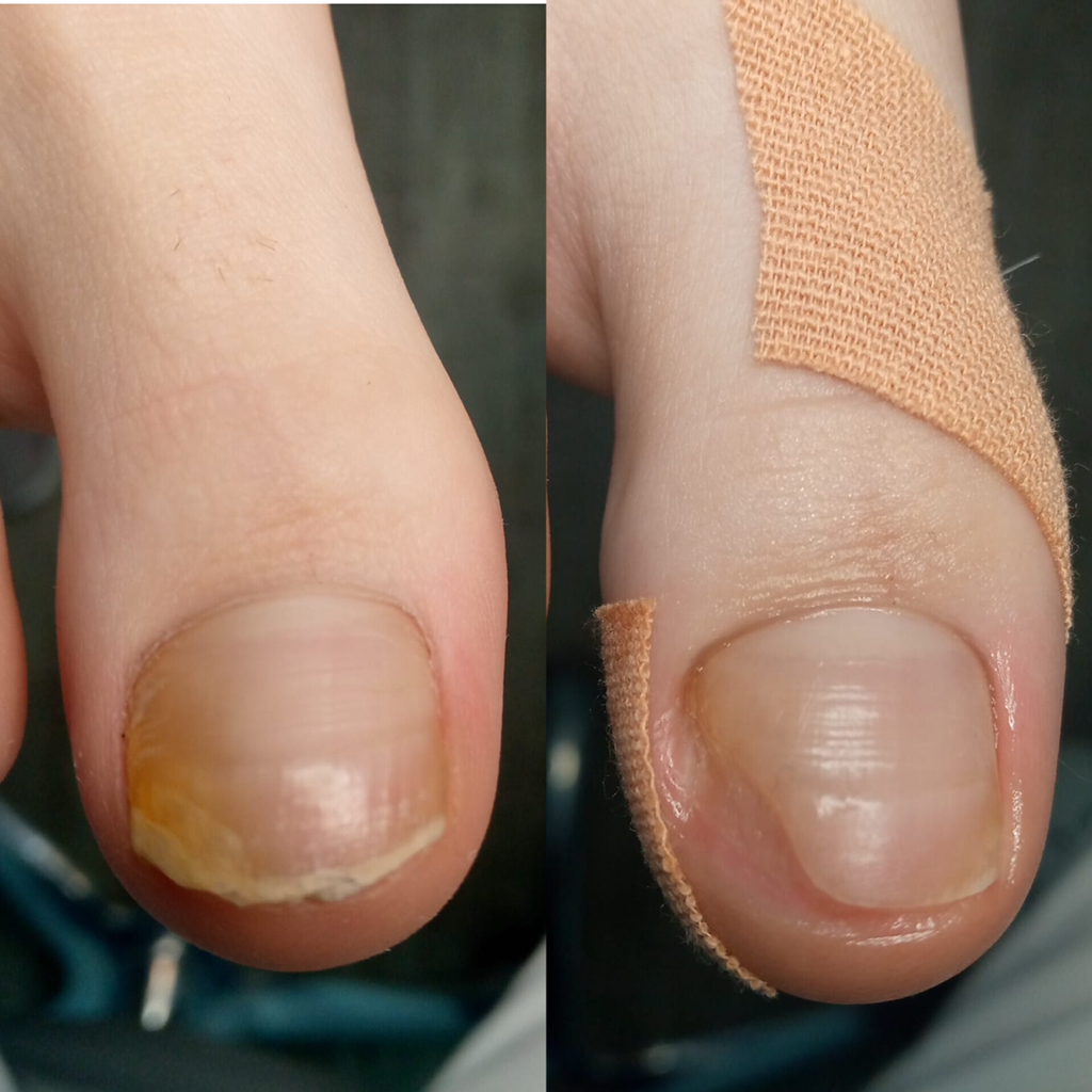 Комплексная обработка стоп и ногтей(2кат)