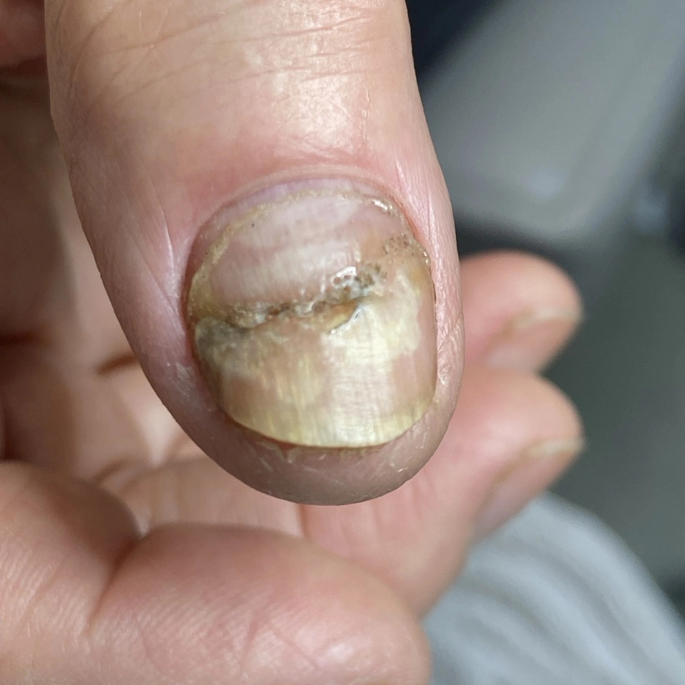 Обработка деформированных/ измененных  ногтей