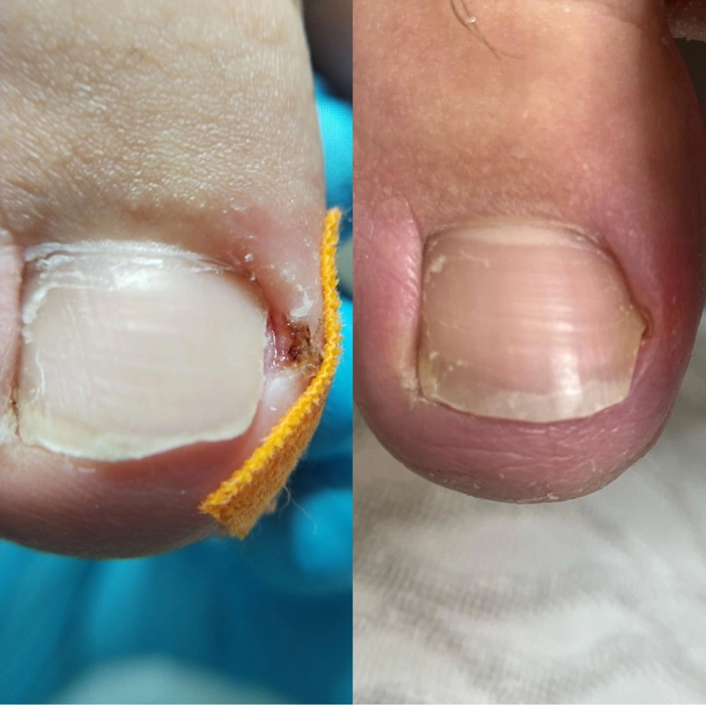 Обработка вросшего ногтя за 1 единицу