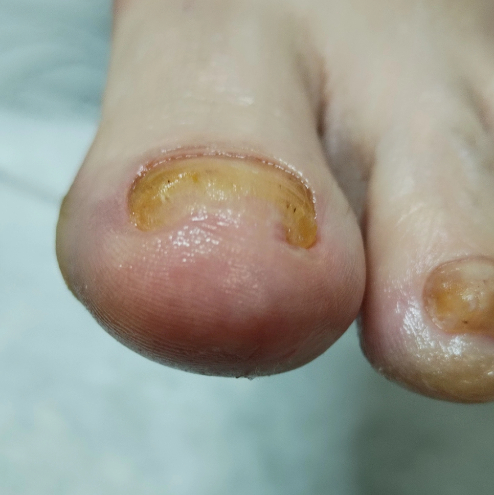 Подологический педикюр