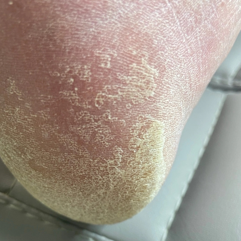 Обработка ног с дерматомикозом (грибок кожи)