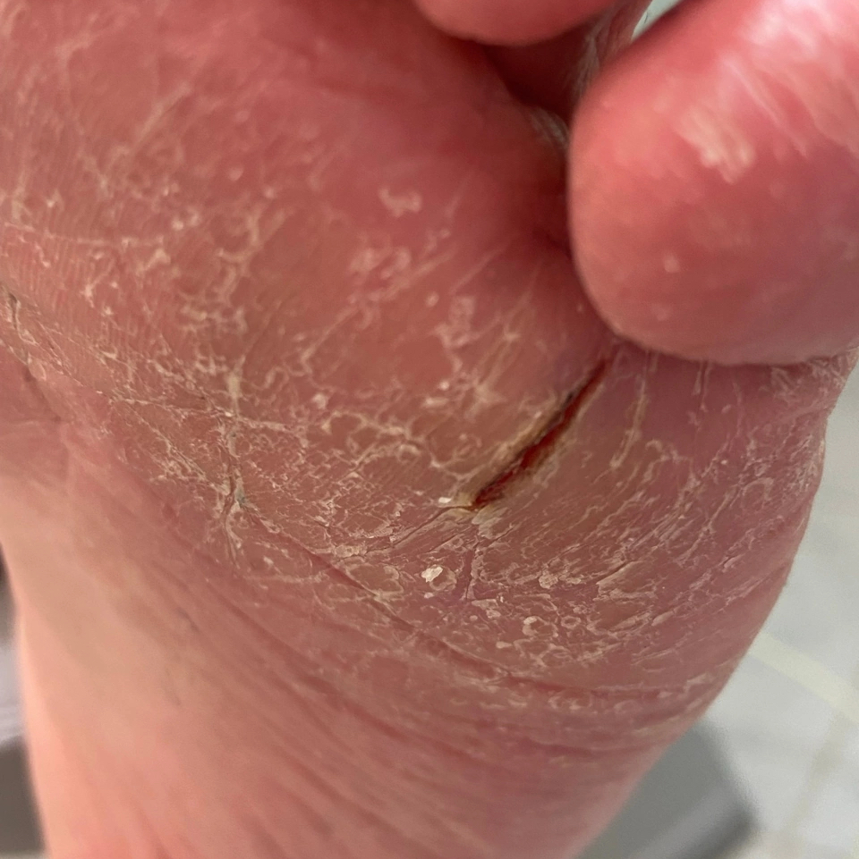 Обработка стопы с трещинами