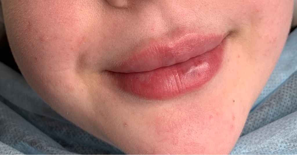 Аугментация губ