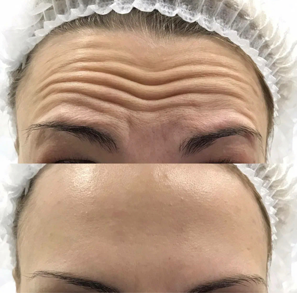 Ботулотоксин (нейропротеин)