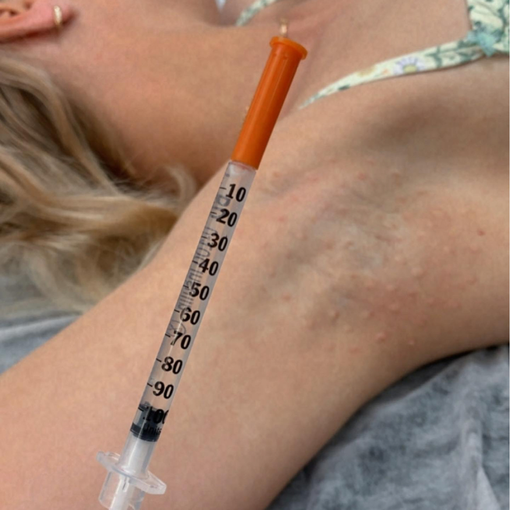 гипергидроз подмышек.   (Избавление от неприятного запаха, от сырых кругов на одежде) эффект на 6-8 месяцев