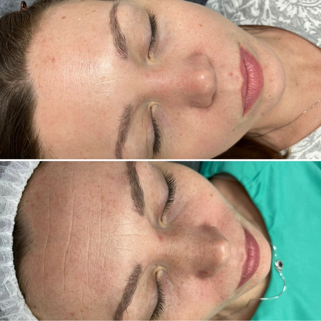 Ультразвуковая чистка лица  ( комплекс )+ пилинг