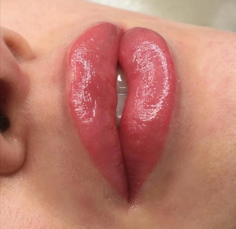 Коррекция губ