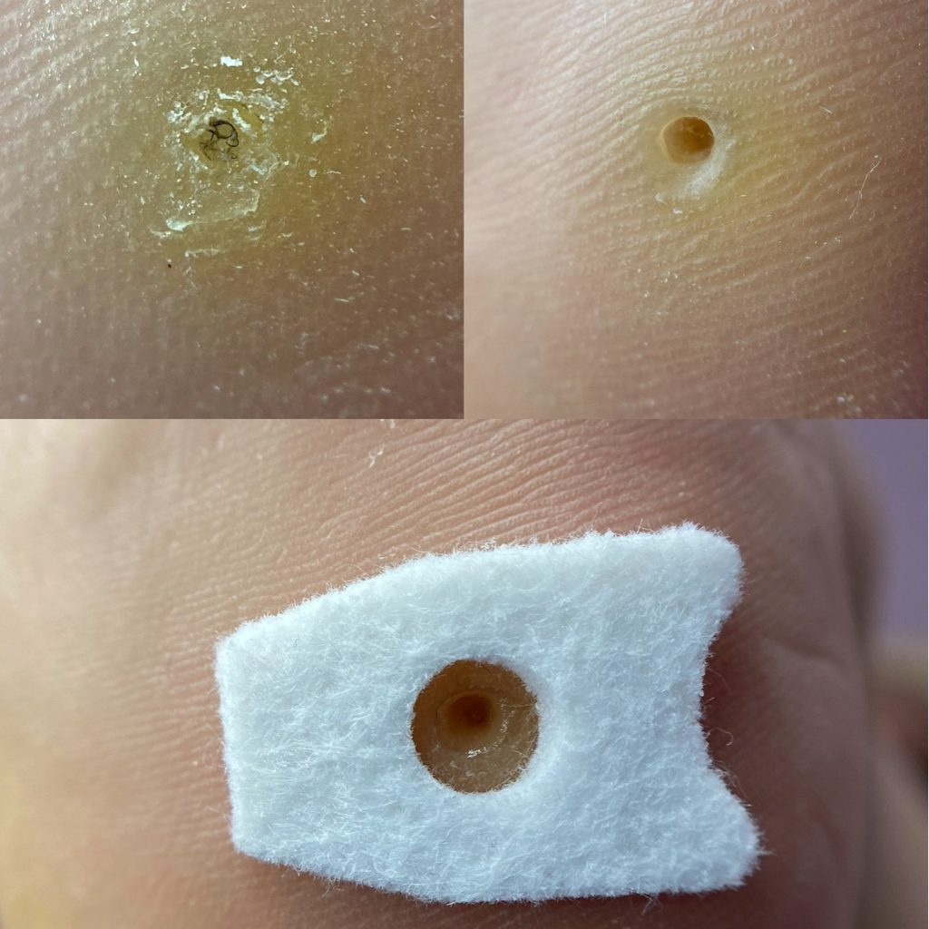 Обработка стержневой мозоли