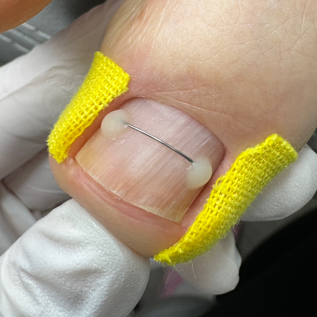 Установка коррекционной системы