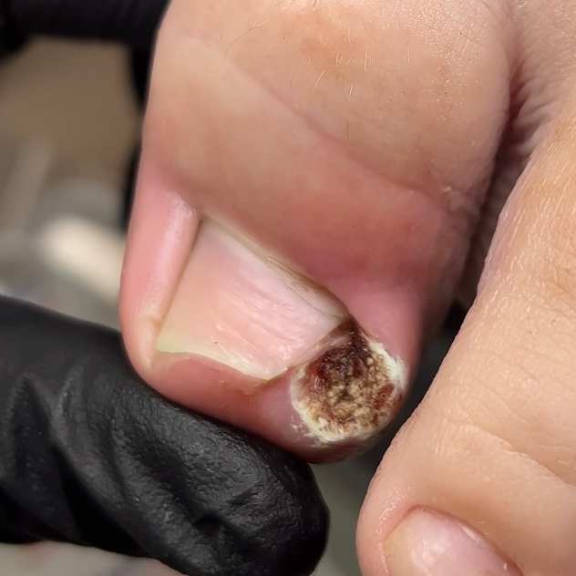 ВРОСШИЙ НОГОТЬ