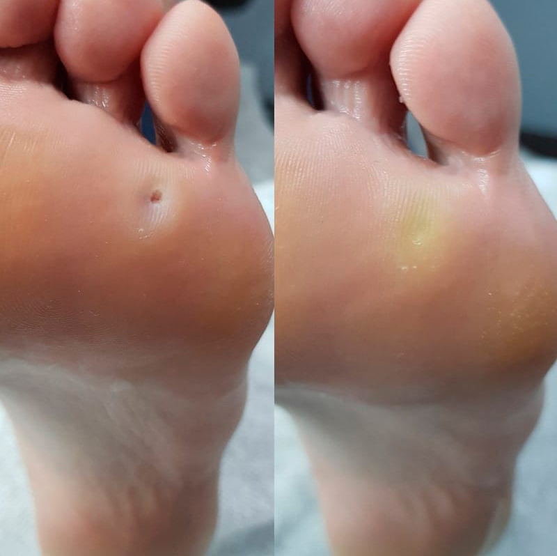 Обработка стержневой мозоли