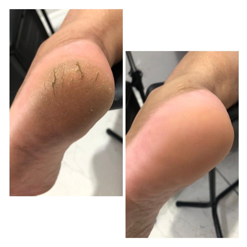 Педикюр карбамидный комбинированный