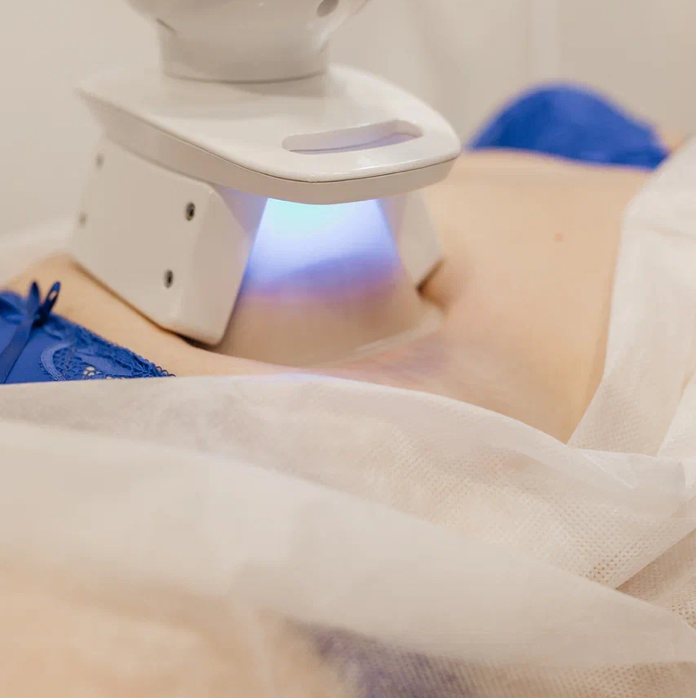 Криолиполиз 1 зона