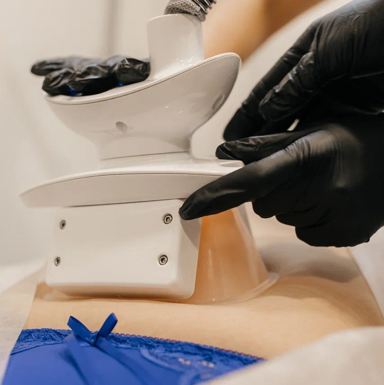 Криолиполиз 2 зоны