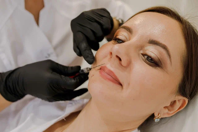 Контурная пластика носогубных складок