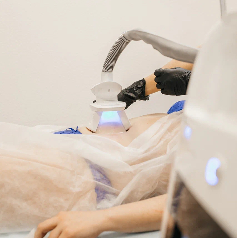 Криолиполиз 3 зоны