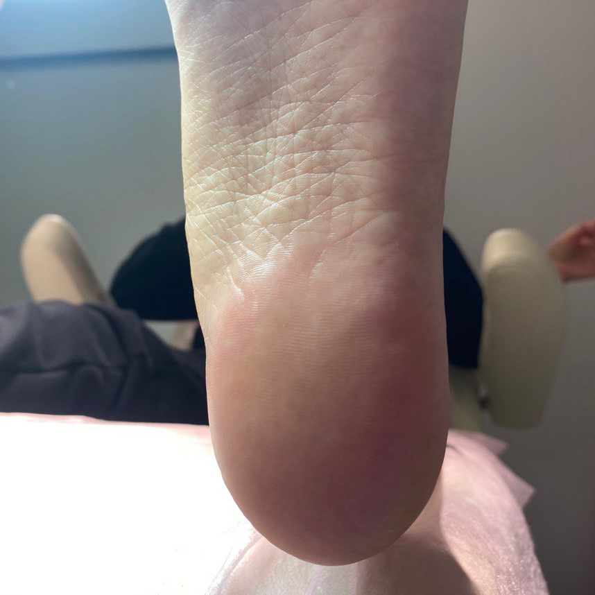 обработка стопы