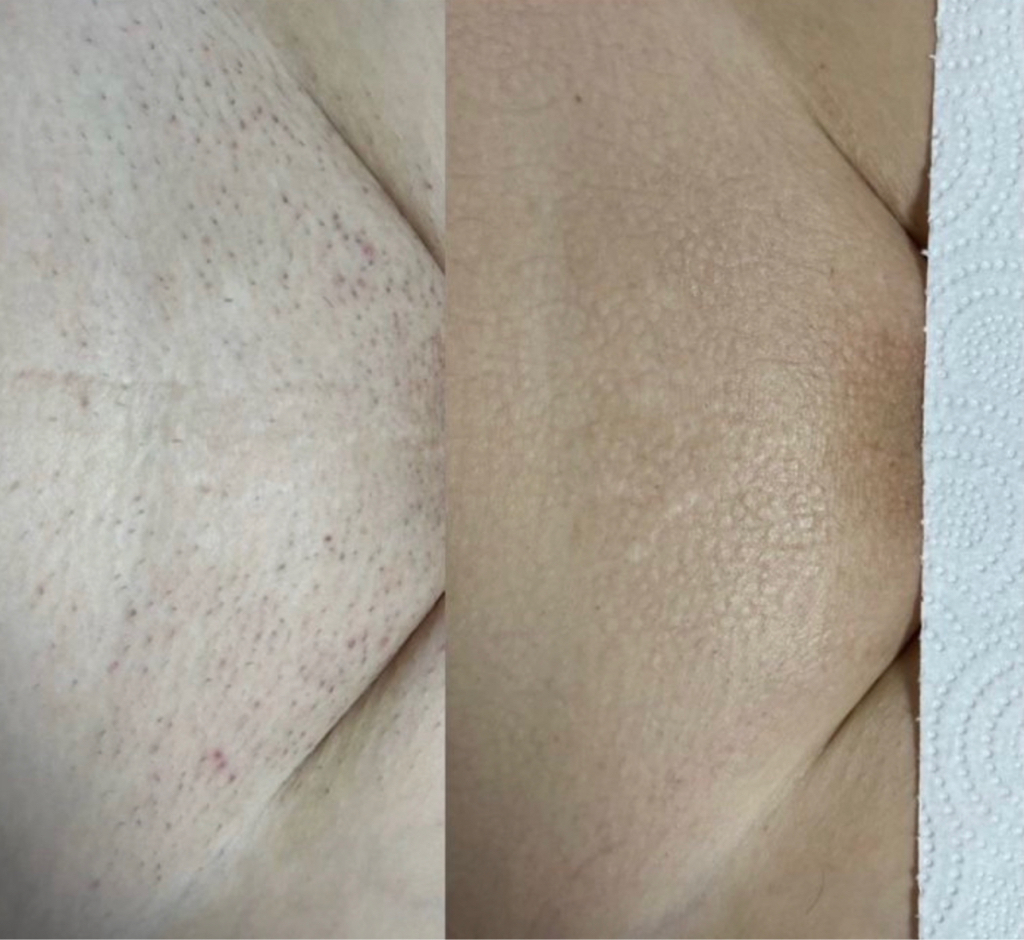 Лазерная эпиляция подмышки+глубокое бикини+ноги полностью 3 сеанса