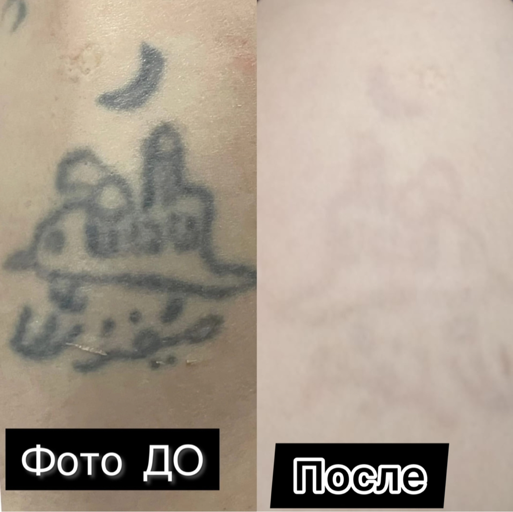 Удаление тату/татуировки