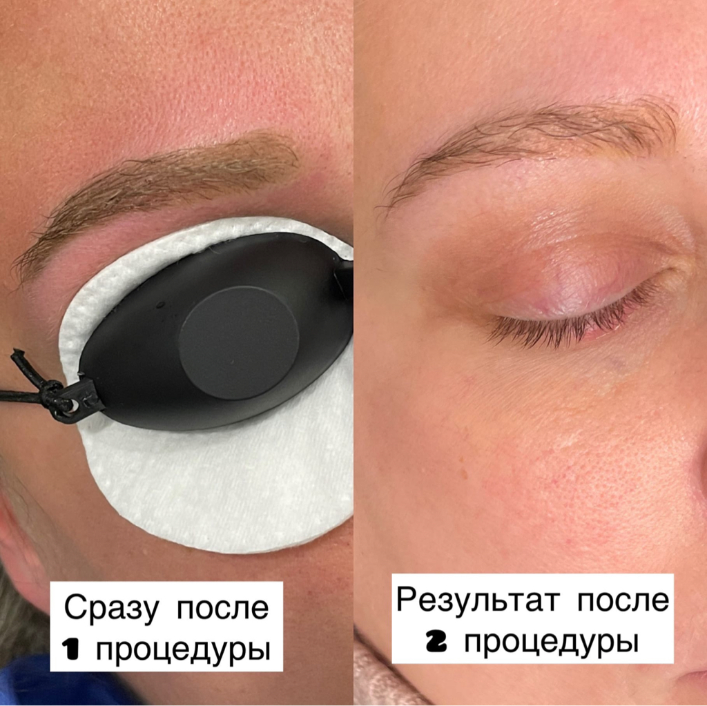 Удаление перманент бровей