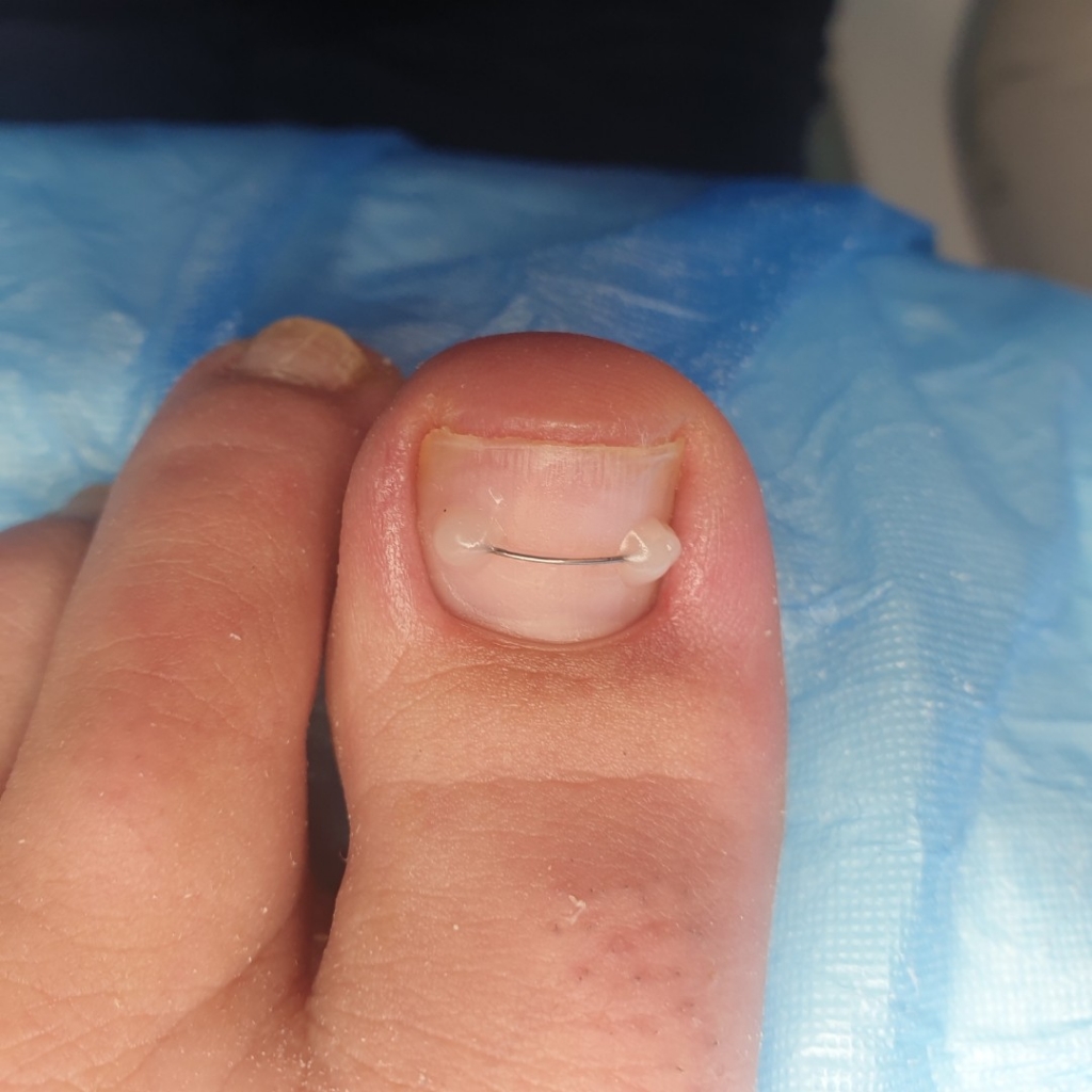 Установка титановой нити