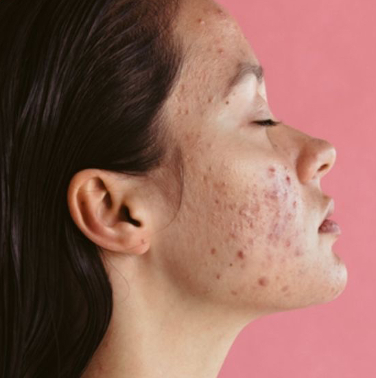 Лечение акне(консультация и назначение процедур, подбор домашнего ухода)