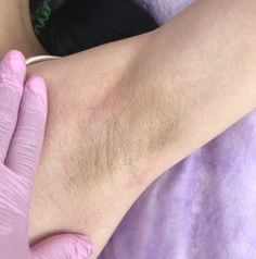 Подмышечные впадины