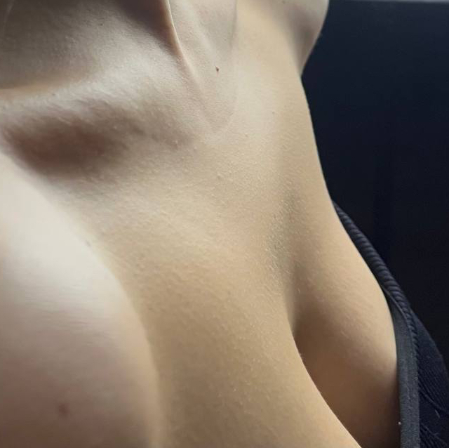 Лазер: Ареолы