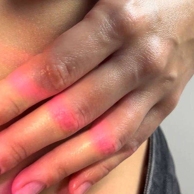 Лазер кисти рук/пальцы