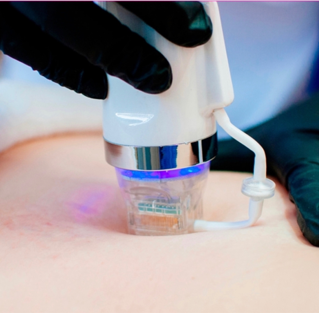 Микроигольчатый Rf-лифтинг лица, шеи, декольте