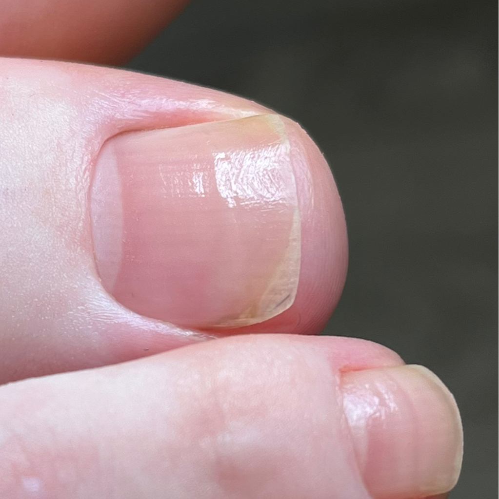 Обработка пальчиков на ногах