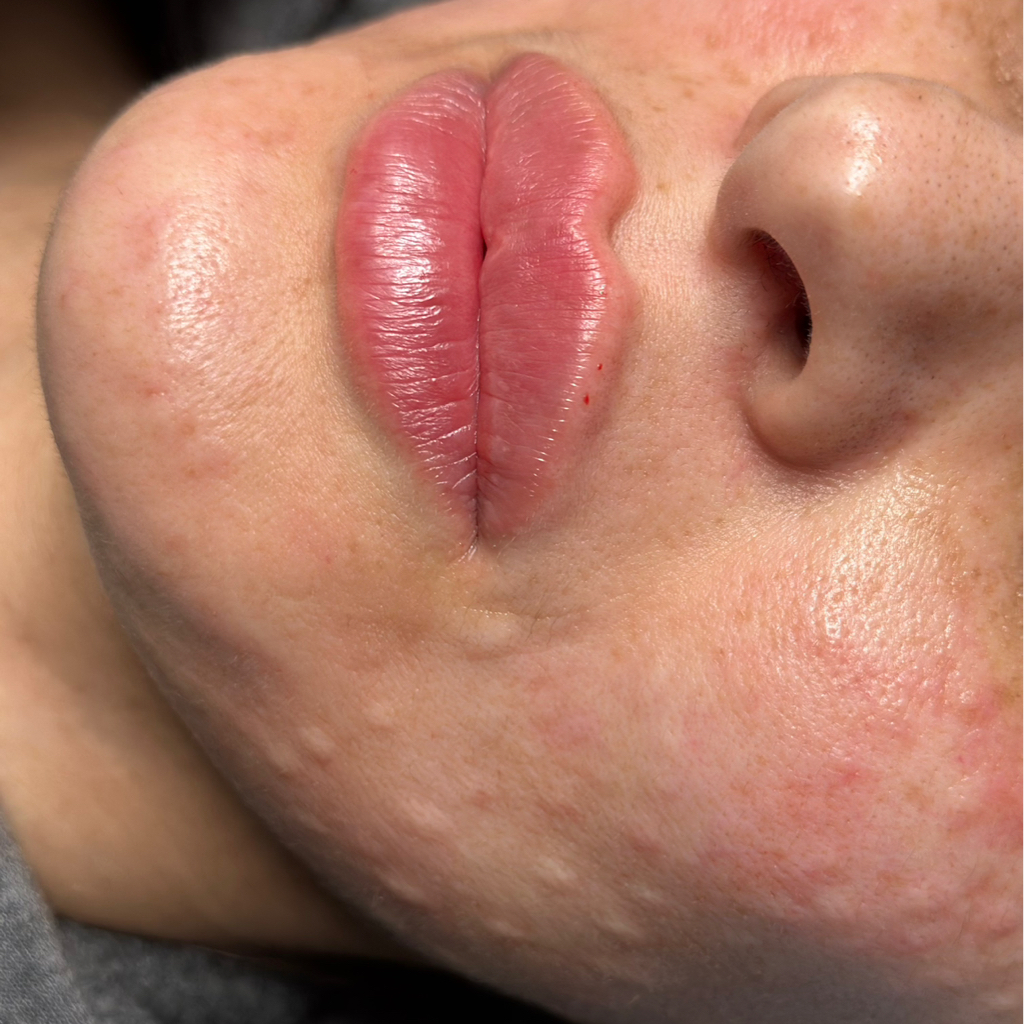 Увеличение губ