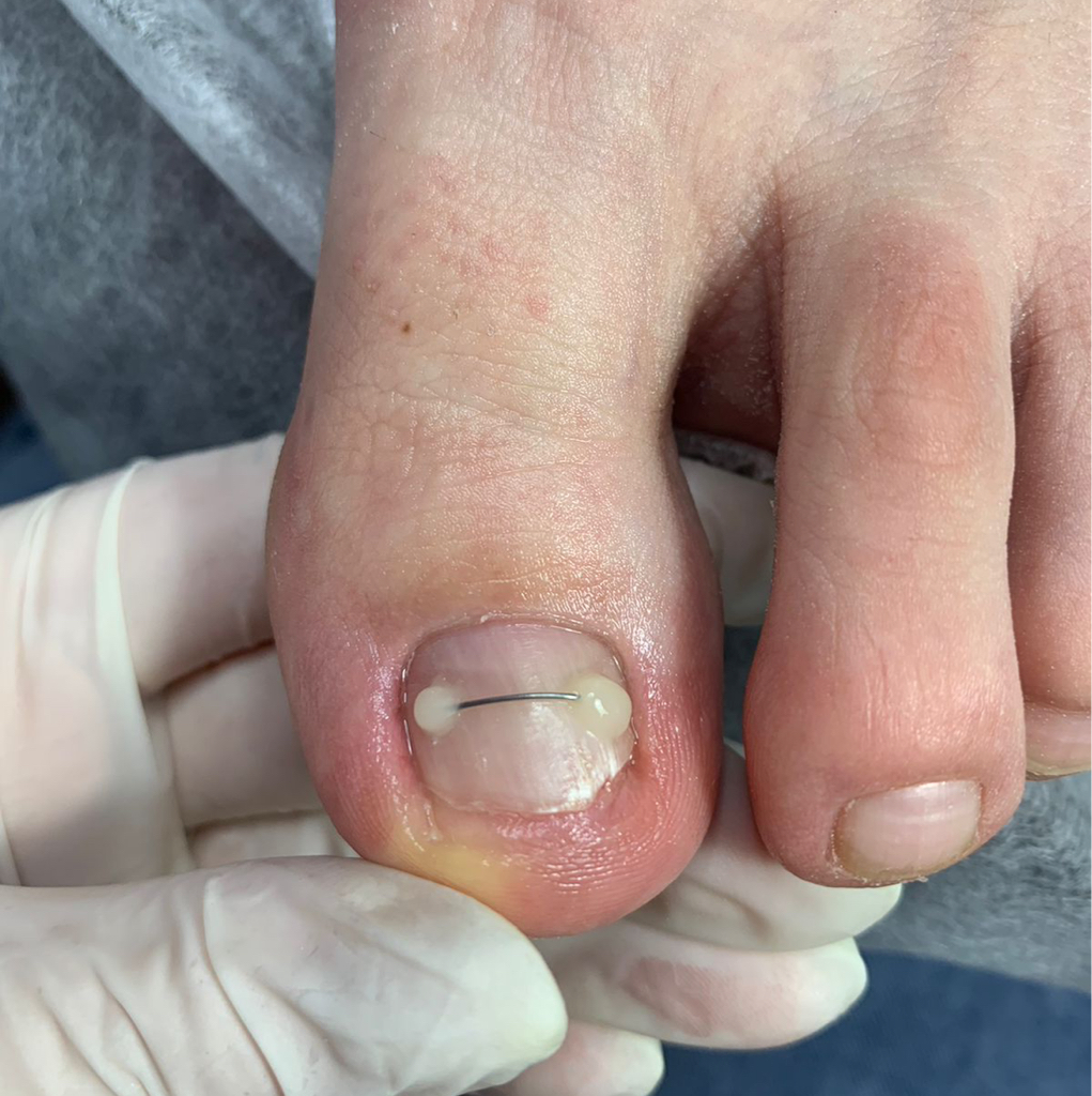 Установка титановой нити