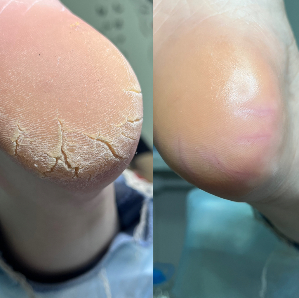 смарт педикюр стопа