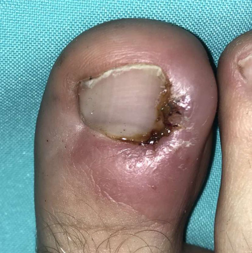 Коррекция вросшего ногтя