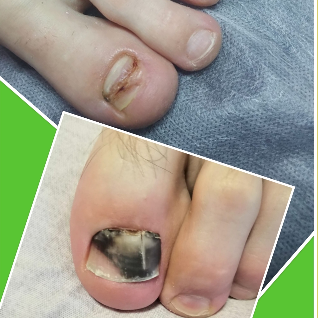 Медицинский педикюр