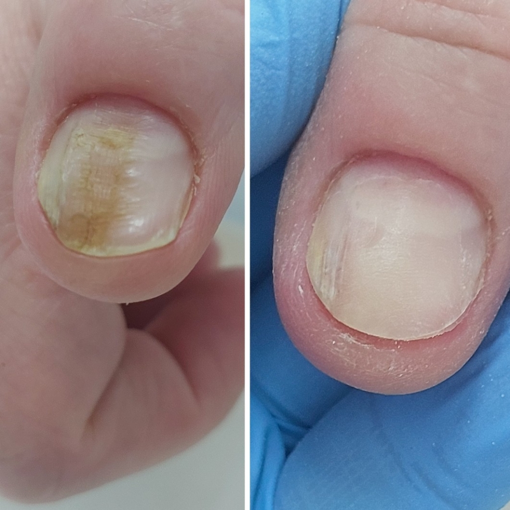 ПРОТЕЗИРОВАНИЕ ногтевой пластины 