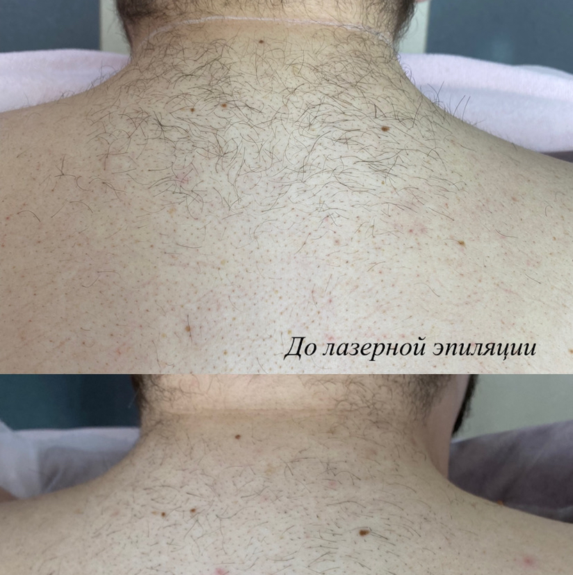 Спина полностью мужская (лазер)