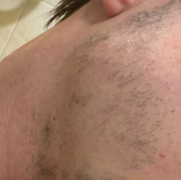 Лицо полностью мужское (лазер)