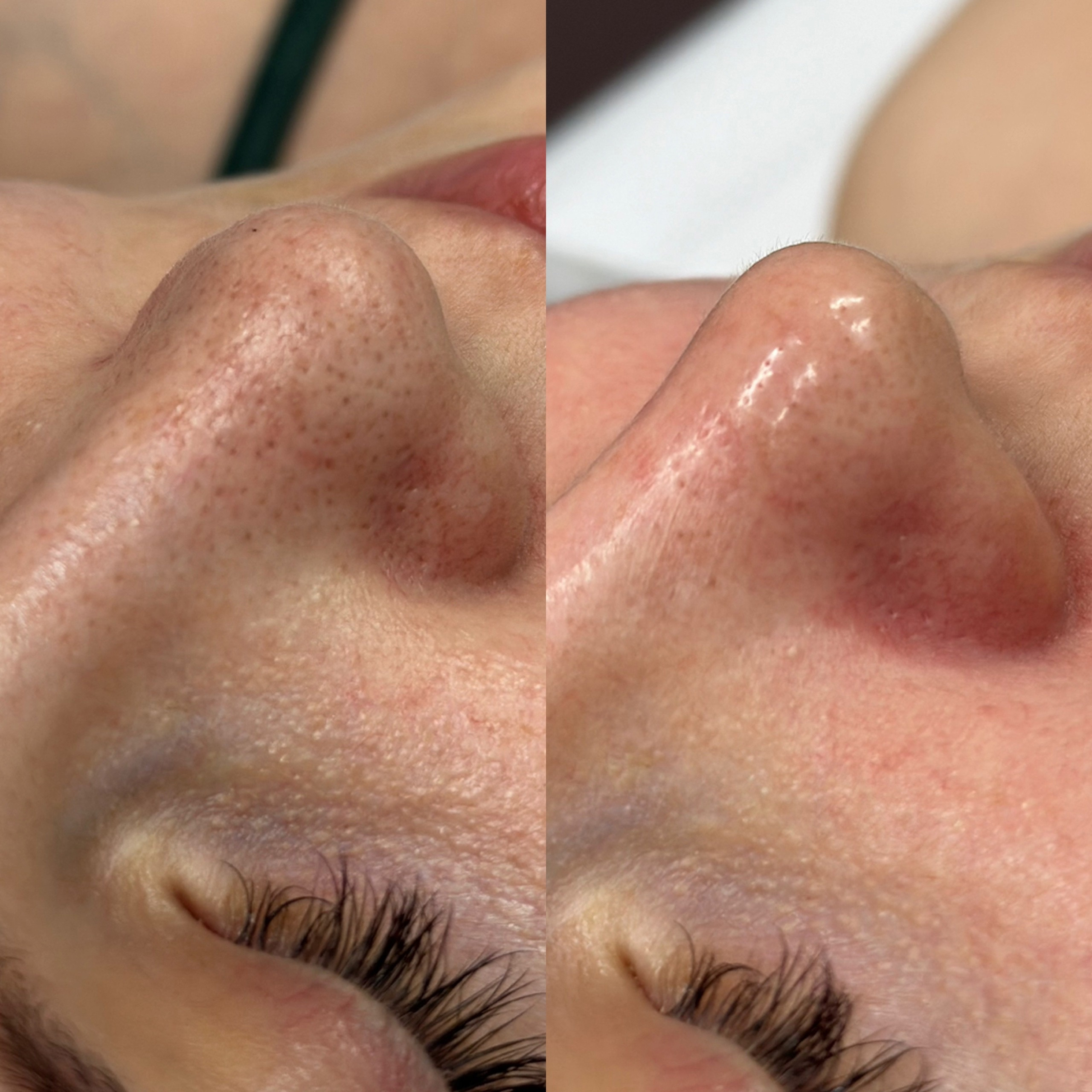 Атравматичная чистка