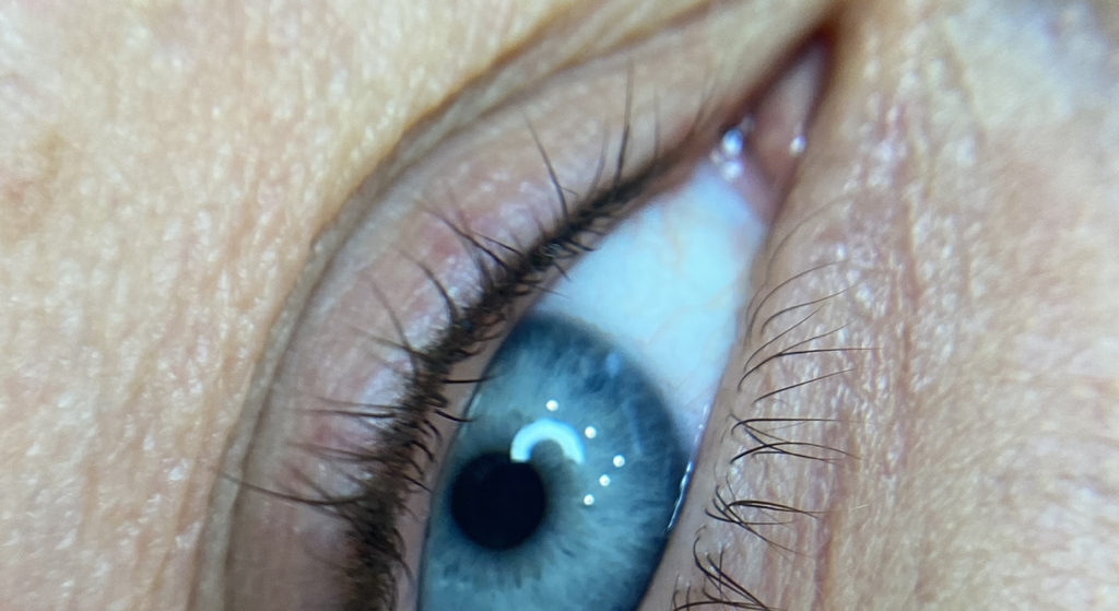 Межресничка