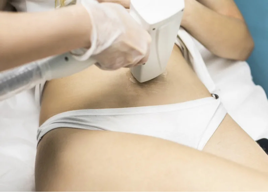 Полосочка на Животе ( абонемент 4 процедуры)