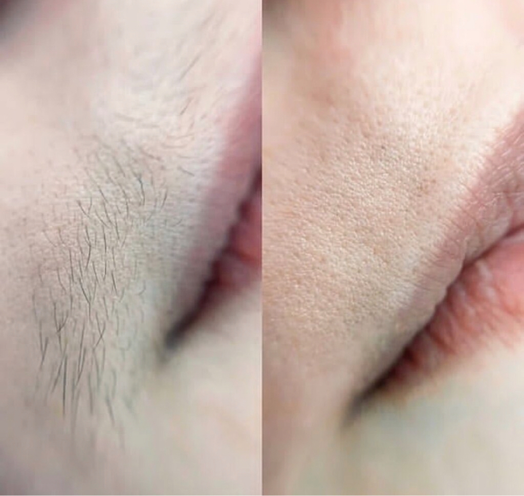 Комплекс:  Усики+ нос